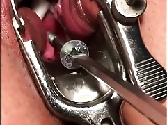 Cervix screwing